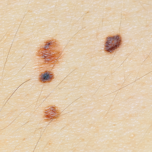 Suspicious Skin Cancer Lesions